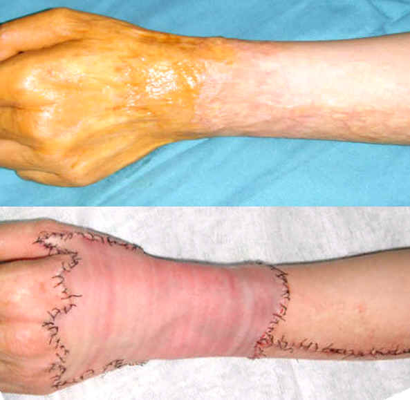 火灾后遗症解决方案,火灾后遗症怎么治疗