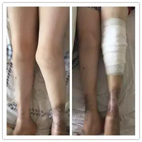 3d打印膝关节置换术效果好吗,膝关节置换3d打印图片