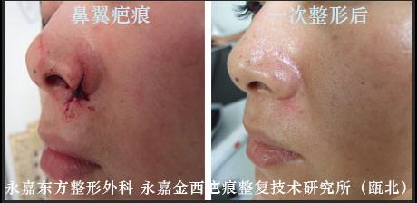 脸上点痣留下的疤痕该怎么办,怎么去除脸上的疤痕