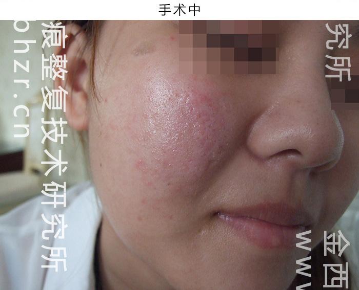 脸上点痣留下的疤痕该怎么办,怎么去除脸上的疤痕