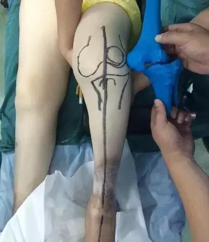 3d打印膝关节置换术效果好吗,膝关节置换3d打印图片