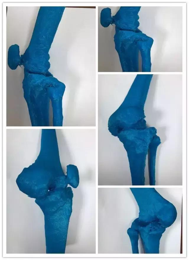 3d打印膝关节置换术效果好吗,膝关节置换3d打印图片