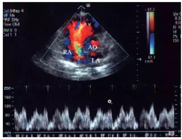 无顶冠型房间隔缺损超声诊断,超声室间隔缺损分型