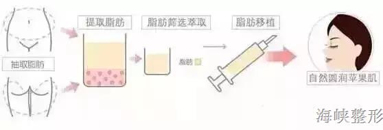 玻尿酸丰脸颊亲身经历,玻尿酸丰太阳穴脸变大了
