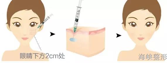 玻尿酸丰脸颊亲身经历,玻尿酸丰太阳穴脸变大了