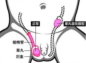 2岁男童少了一个蛋蛋,宝妈惊慌不知所措