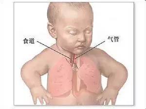 父母应该高度重视的新生儿肺炎！