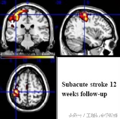 虚拟情景训练治疗,虚拟康复训练技术
