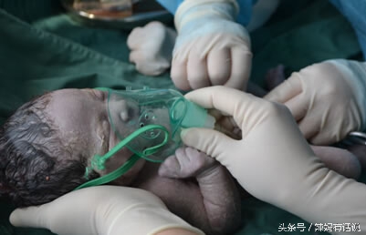 孕33周胎膜早破早产胎儿的成活率,孕妈妈早产会有哪些迹象