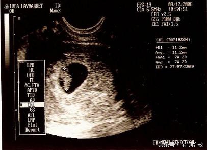 胎囊怎么确定是不是双胞胎,胎囊尺寸辨别宝宝性格