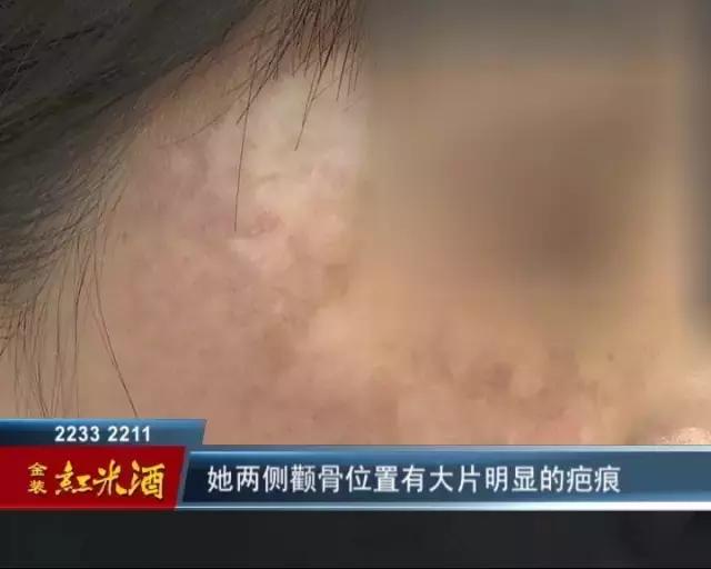 药水祛斑毁容能恢复吗,药水祛斑的后遗症