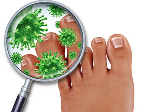 杀灭脚气真菌不如2%碘酊有效,治脚气杀真菌最好的不含激素类药