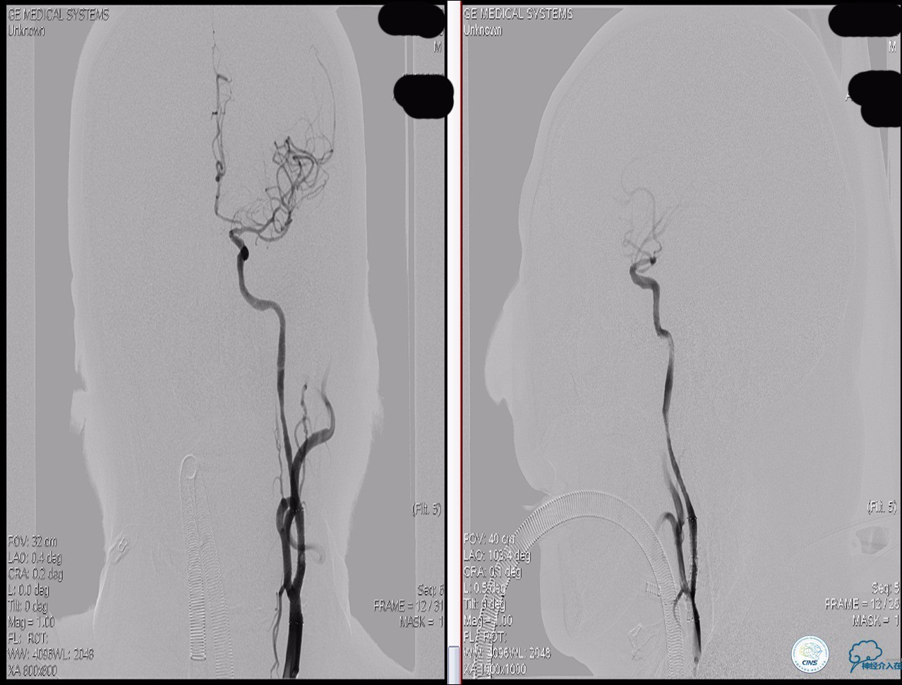颈动脉次全闭塞,颈动脉次全闭塞中医疗法