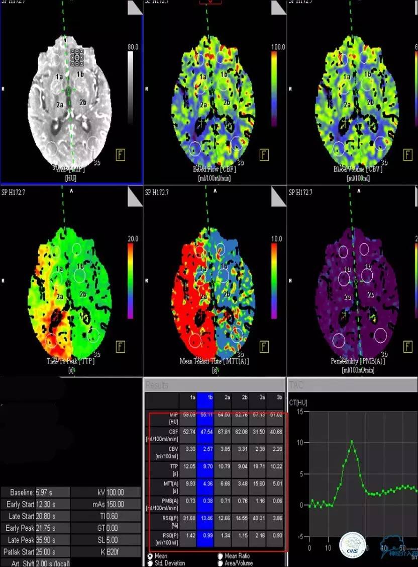 颈动脉次全闭塞,颈动脉次全闭塞中医疗法
