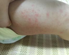 儿童湿疹引起皮肤溃烂怎么办,婴儿皮肤湿疹怎么处理