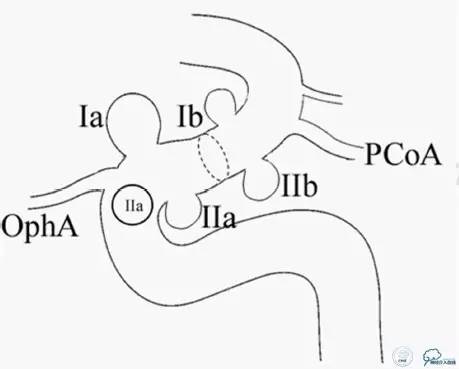 床突旁动脉瘤的血管内治疗