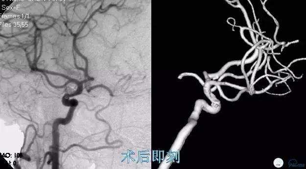 床突旁动脉瘤的血管内治疗