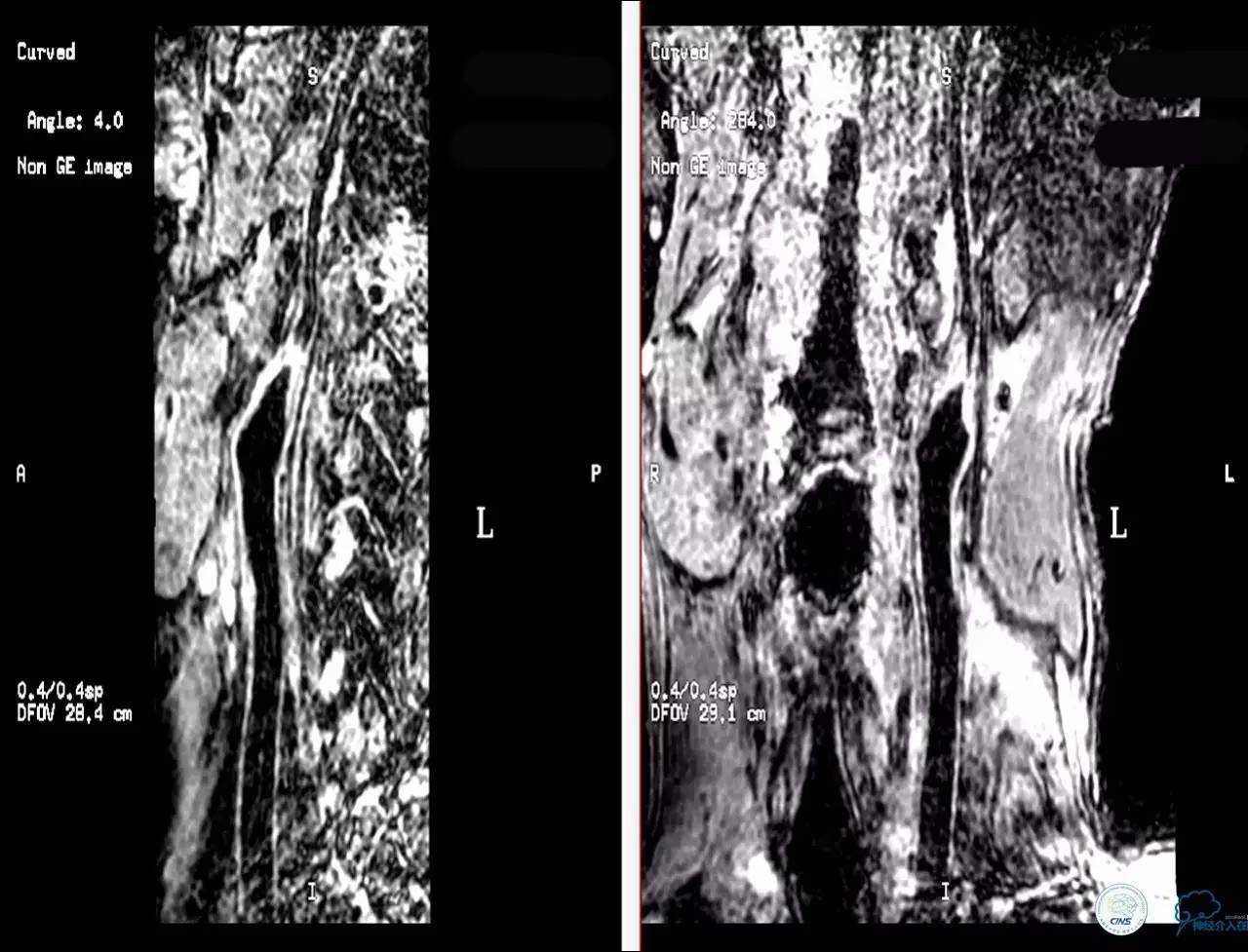 颈动脉次全闭塞,颈动脉次全闭塞中医疗法