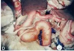 床突旁动脉瘤的血管内治疗