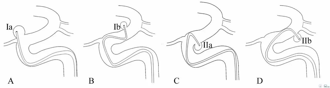 床突旁动脉瘤的血管内治疗