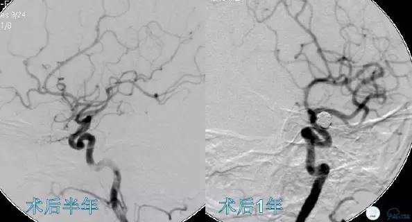 床突旁动脉瘤的血管内治疗