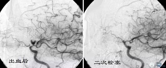 床突旁动脉瘤的血管内治疗