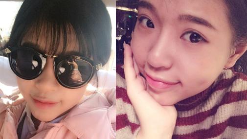 玻尿酸隆鼻的效果到底怎么样啊,玻尿酸隆鼻是不是适合每个人