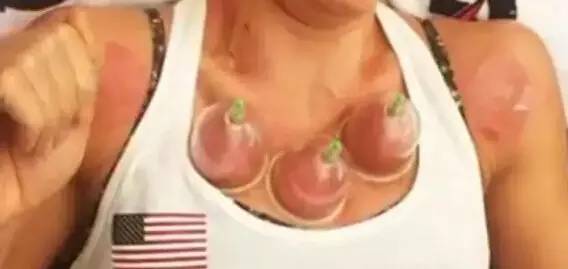 拔火罐有真空原理吗,拔火罐的来源