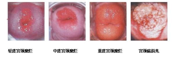 所有的妇科病都可以彻底治愈吗,这5种妇科疾病真的不用治