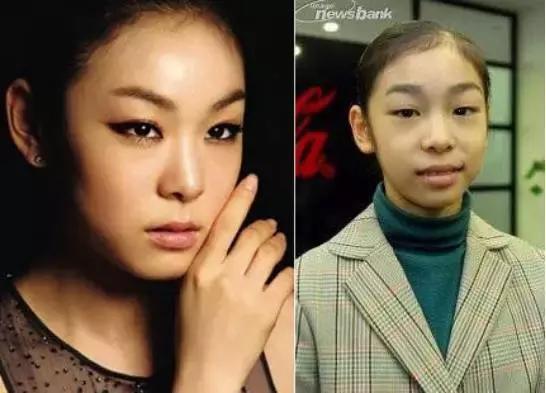 奥运冠军也爱美瘦脸箍牙后她们都美啦