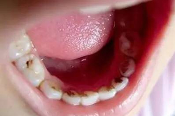 一岁宝宝色素牙怎么改善,一岁小孩牙肉黑什么原因