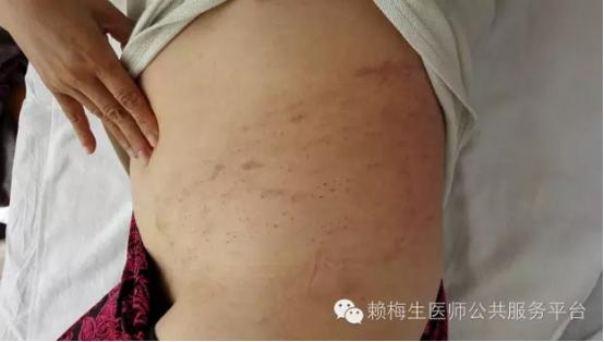 董氏奇穴治疗带状疱疹后遗症,董氏奇穴全身痒