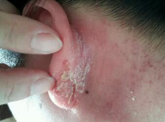 湿疹是不是春天高发,湿疹经常做这些事好得快