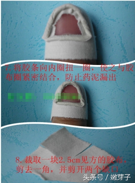 灰指甲包甲步骤及用药