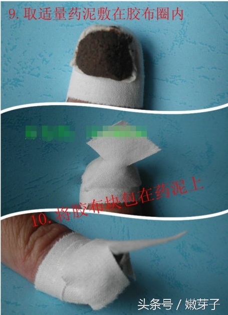 灰指甲包甲步骤及用药