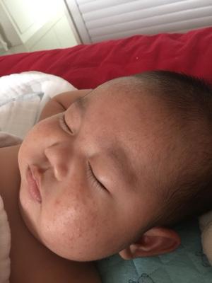 婴儿湿疹和奶粉过敏湿疹怎么区别,宝宝湿疹治疗有效的方法