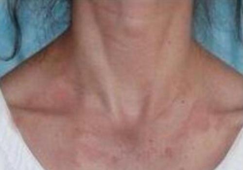 顽固性湿疹的民间秘方,皮肤病湿疹止痒秘方