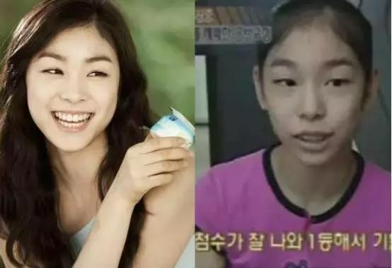 奥运冠军也爱美瘦脸箍牙后她们都美啦