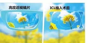 超高度近视手术治疗案例,超高度近视icl晶体植入