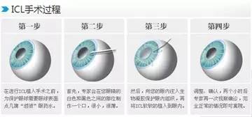 超高度近视手术治疗案例,超高度近视icl晶体植入