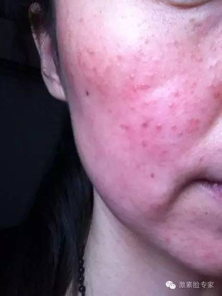 激素依赖性皮炎痊愈患者自述,面部激素皮炎怎么治愈