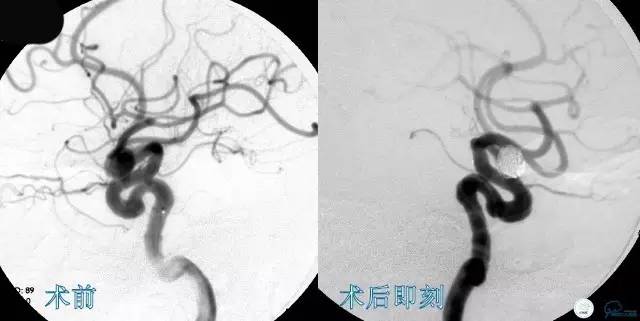 床突旁动脉瘤的血管内治疗