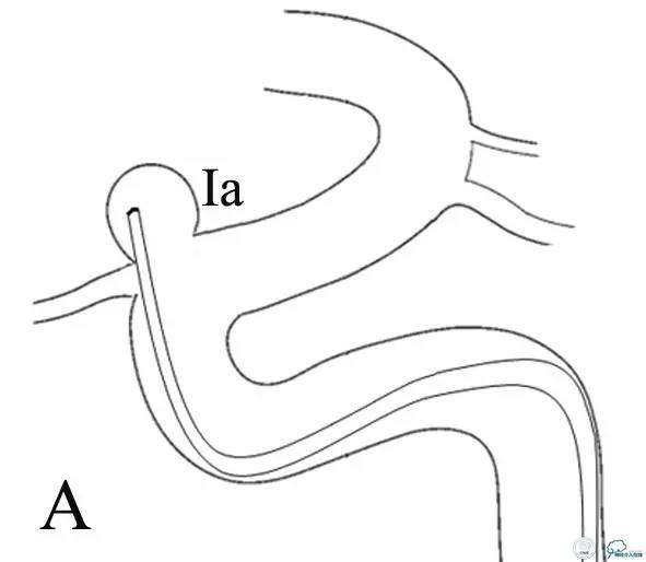 床突旁动脉瘤的血管内治疗