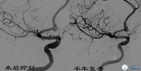 床突旁动脉瘤的血管内治疗