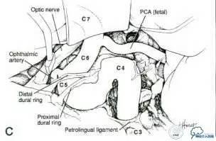 床突旁动脉瘤的血管内治疗