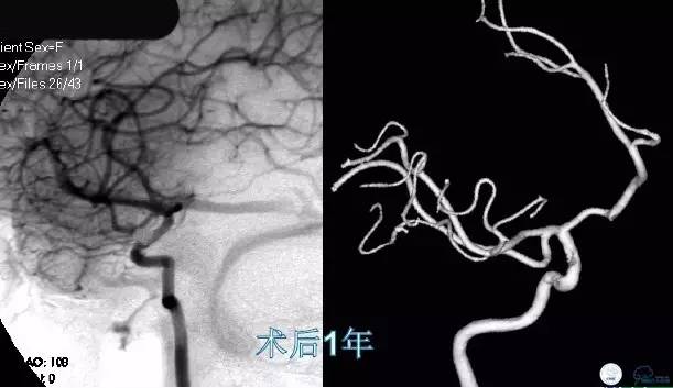 床突旁动脉瘤的血管内治疗