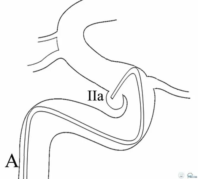 床突旁动脉瘤的血管内治疗