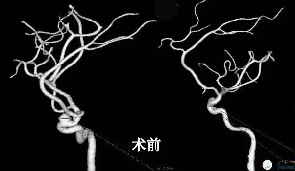 床突旁动脉瘤的血管内治疗