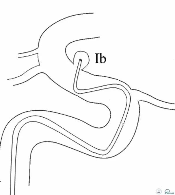床突旁动脉瘤的血管内治疗