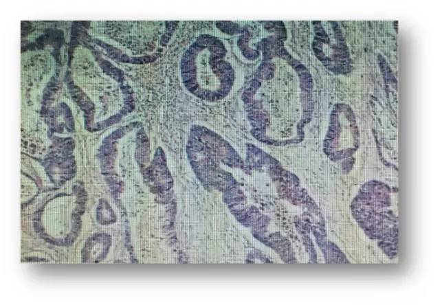 肠癌肝转移同时性和异时性,邢宝才治疗肠癌肝转移成功病例